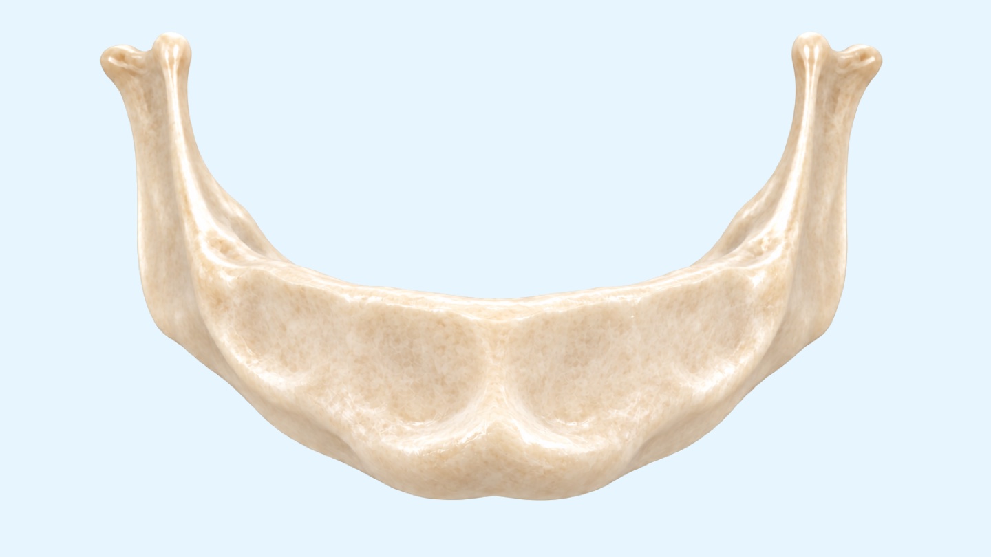 İstanbul'da All-on-6 implant: All-on-6 implantların nasıl yerleştirildiğini gösteren alt çene 3D çizimi