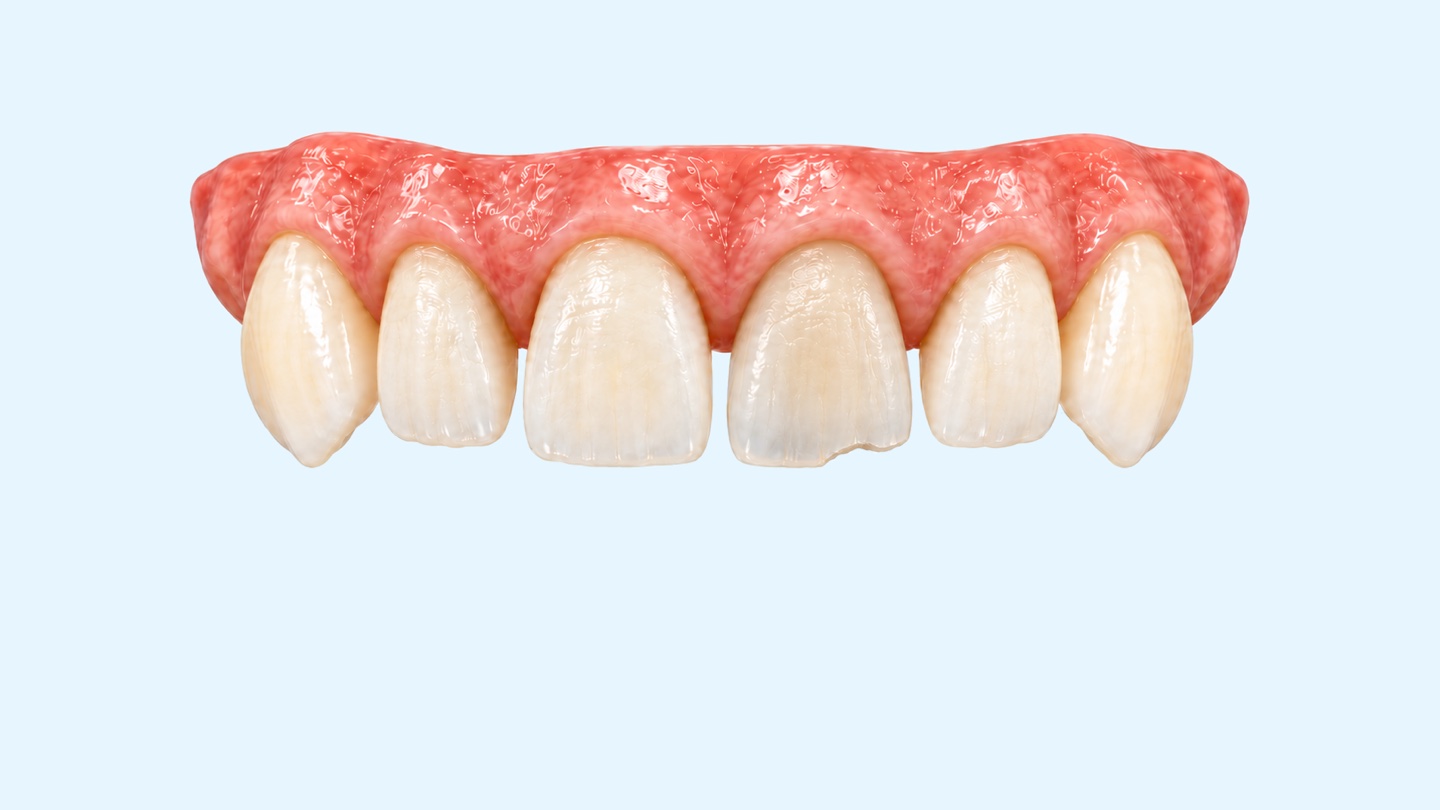 E-max crowns in Turkey: 3D illustration of the upper front teeth showing how a front tooth is prepared and an E-max crown is bonded