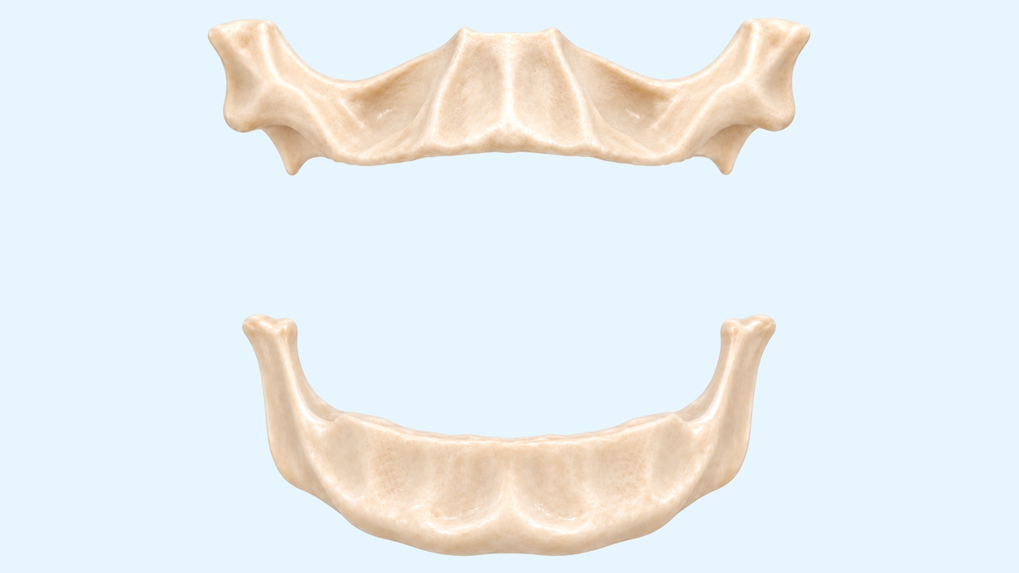 Full mouth dental implants procedure, 3D illustration: implants and fixed bridges in the upper and lower jaw