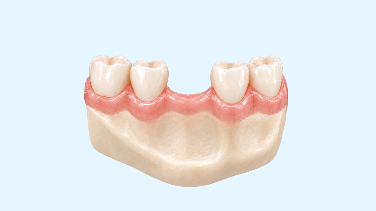 İstanbul'da diş implantı: doğal dişler arasındaki eksik dişin diş implantıyla nasıl tamamlandığını gösteren alt çene kesiti 3D çizimi