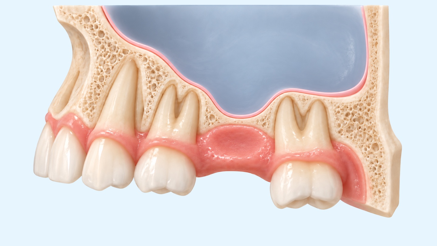 İstanbul'da sinüs lifting: sinüs tabanının kaldırıldığını, kemik grefti eklendiğini ve implant yerleştirildiğini gösteren üst çene arka bölgesinin 3D kesit çizimi