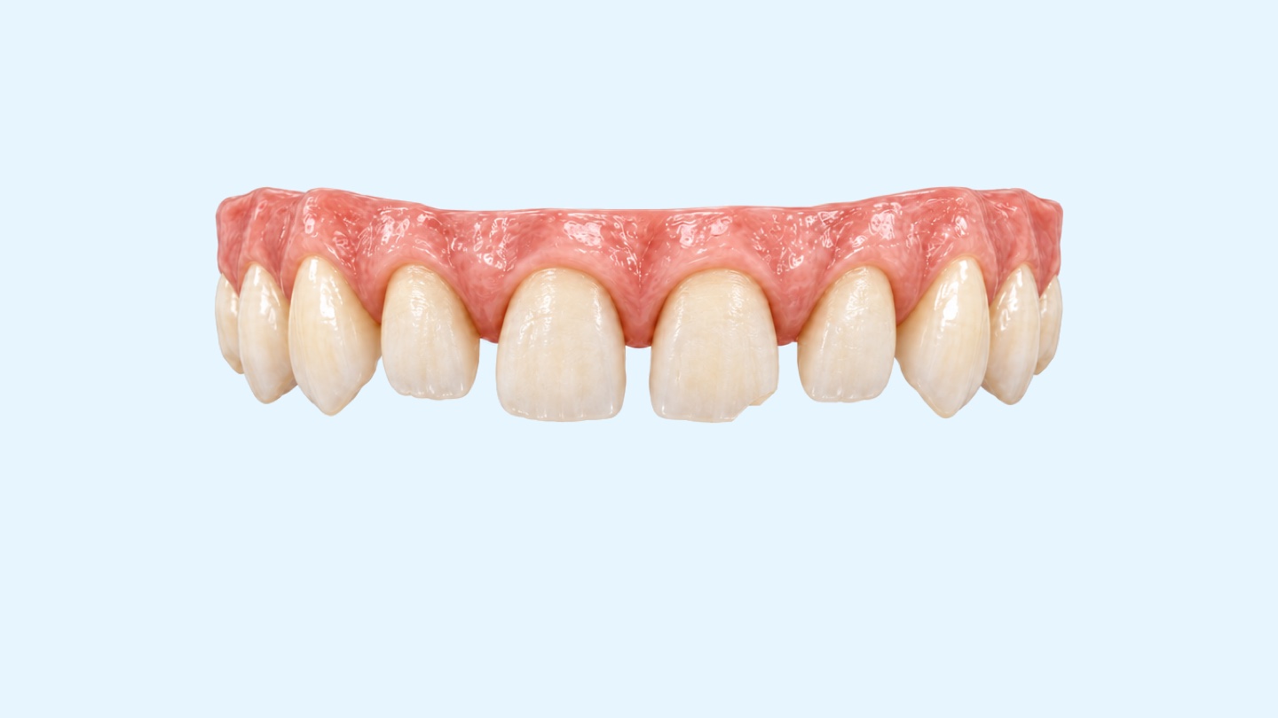 Smile makeover with porcelain veneers, 3D illustration: prepared upper front teeth and veneers