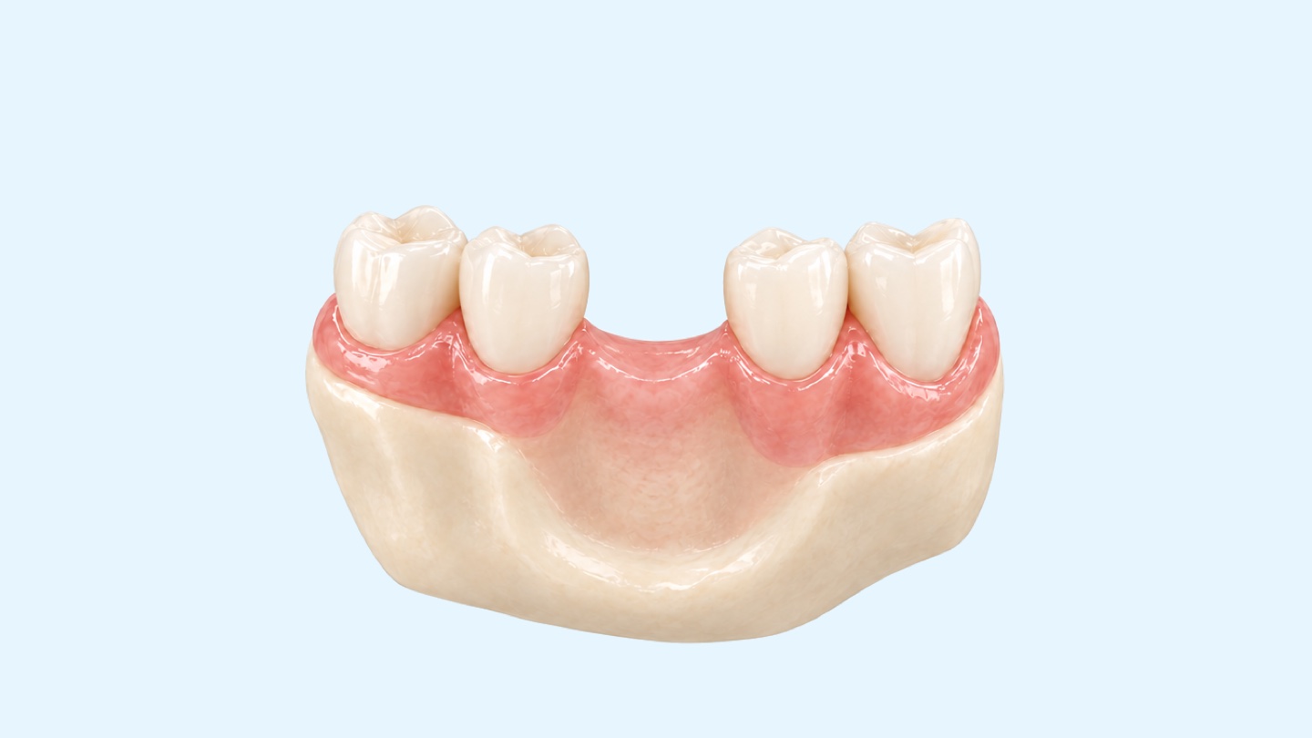 Zirkonyum implant: beyaz zirkonyum implantın eksik bir dişi nasıl tamamladığını gösteren çene kesiti 3D çizimi