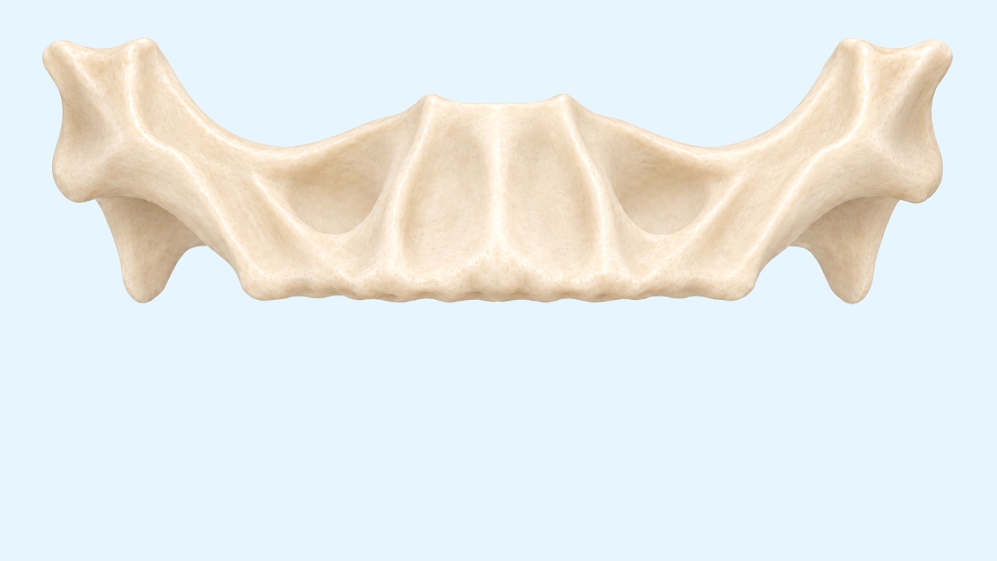 Zygomatic implants procedure, 3D illustration: long implants anchored in the cheekbones and an upper bridge